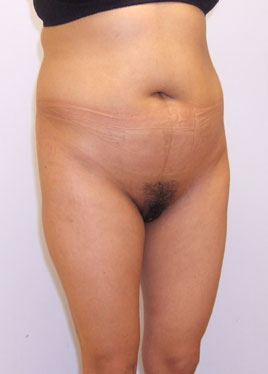 Tummy Tuck Before & After Image