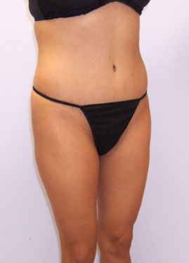 Tummy Tuck Before & After Image