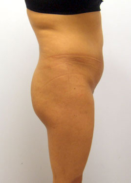 Tummy Tuck Before & After Image