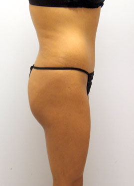 Tummy Tuck Before & After Image