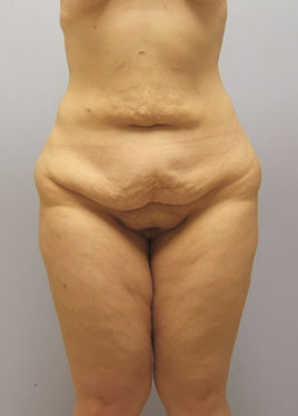 Tummy Tuck Before & After Image