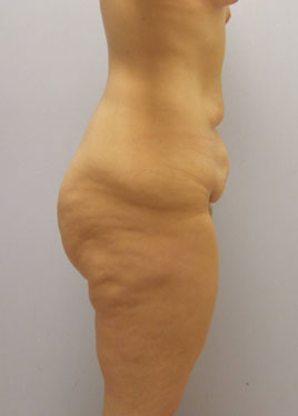 Tummy Tuck Before & After Image