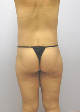 Tummy Tuck Before & After Image