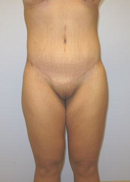 Tummy Tuck Before & After Image