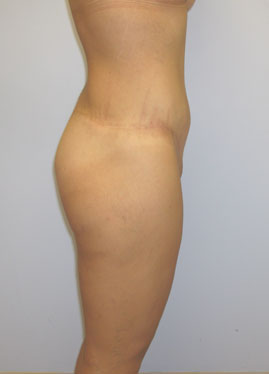 Tummy Tuck Before & After Image