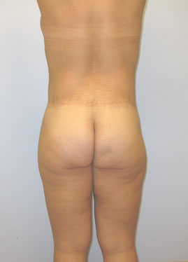 Tummy Tuck Before & After Image