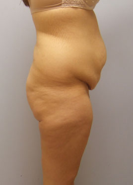 Tummy Tuck Before & After Image