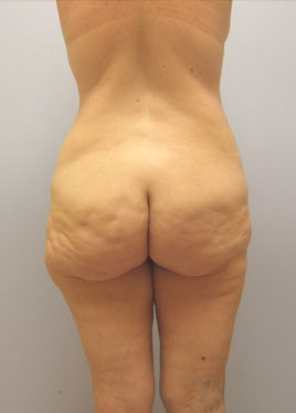 Tummy Tuck Before & After Image