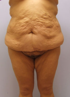 Tummy Tuck Before & After Image