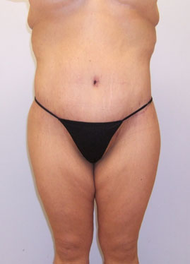 Tummy Tuck Before & After Image