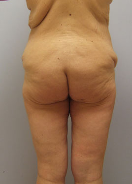 Tummy Tuck Before & After Image