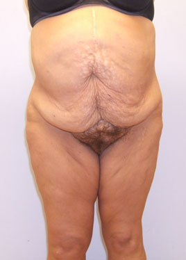 Tummy Tuck Before & After Image