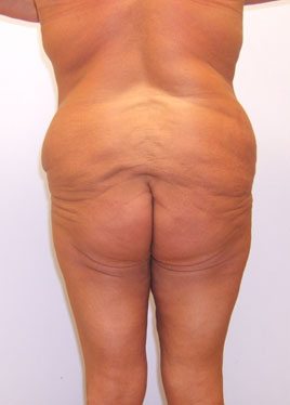 Tummy Tuck Before & After Image