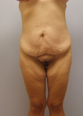 Tummy Tuck Before & After Image