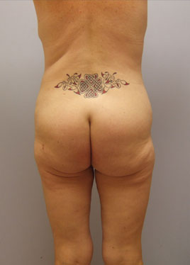 Tummy Tuck Before & After Image