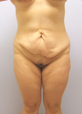 Tummy Tuck Before & After Image