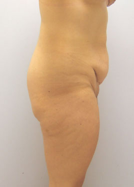 Tummy Tuck Before & After Image