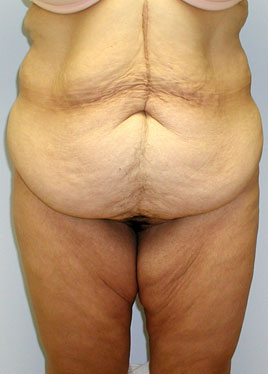 Tummy Tuck Before & After Image