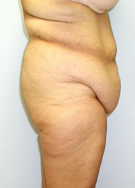 Tummy Tuck Before & After Image