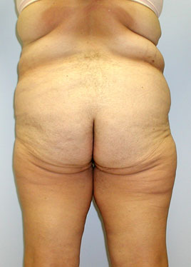 Tummy Tuck Before & After Image