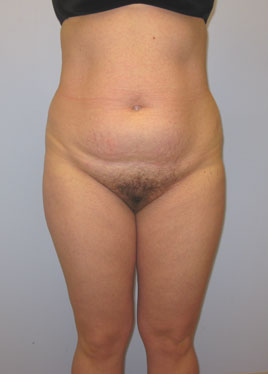 Tummy Tuck Before & After Image