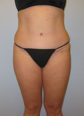 Tummy Tuck Before & After Image