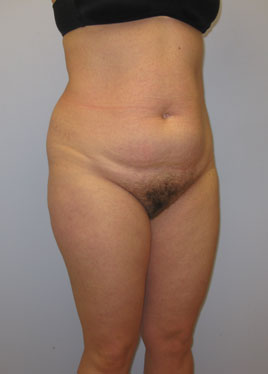 Tummy Tuck Before & After Image