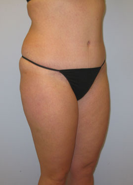 Tummy Tuck Before & After Image