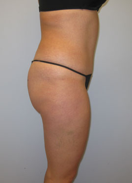 Tummy Tuck Before & After Image