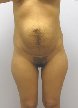 Tummy Tuck Before & After Image