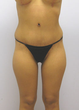 Tummy Tuck Before & After Image