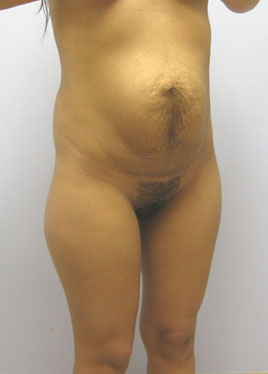 Tummy Tuck Before & After Image