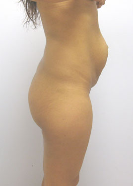 Tummy Tuck Before & After Image