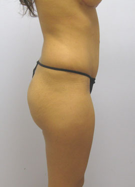 Tummy Tuck Before & After Image