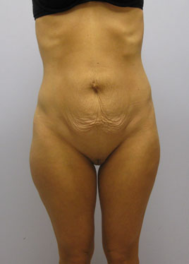 Tummy Tuck Before & After Image