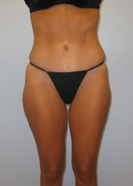 Tummy Tuck Before & After Image