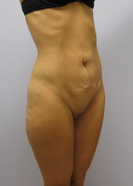 Tummy Tuck Before & After Image