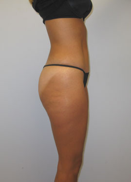 Tummy Tuck Before & After Image