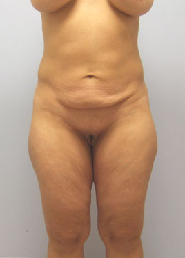 Tummy Tuck Before & After Image