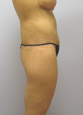 Tummy Tuck Before & After Image