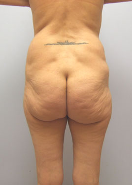 Tummy Tuck Before & After Image