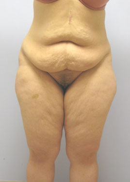 Tummy Tuck Before & After Image