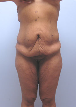 Tummy Tuck Before & After Image