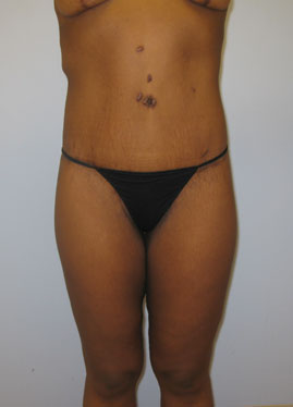 Tummy Tuck Before & After Image