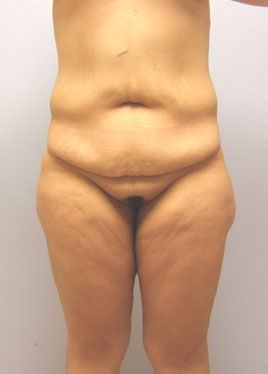 Tummy Tuck Before & After Image