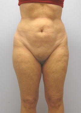 Tummy Tuck Before & After Image