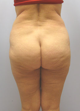 Tummy Tuck Before & After Image