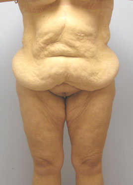 Tummy Tuck Before & After Image