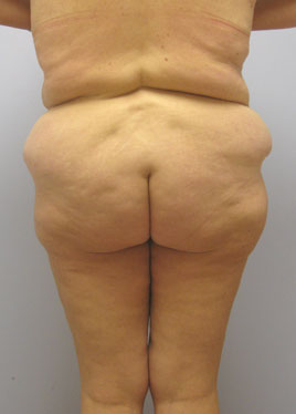 Tummy Tuck Before & After Image