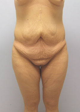 Tummy Tuck Before & After Image